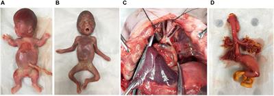 The Added Value of Whole-Exome Sequencing for Anomalous Fetuses With Detailed Prenatal Ultrasound and Postnatal Phenotype